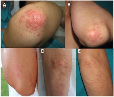 Summer and spring elbow rashes is a variant of polymorphous light eruption: confirmation by photoprovocation and histopathology in a series of five cases